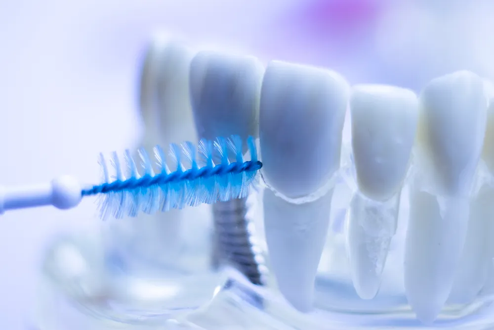 Kebaikan Berus Interdental untuk Gigi